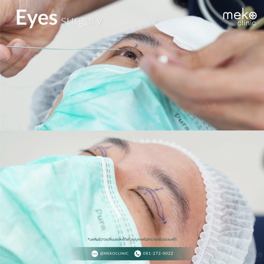 วิธีผ่าตัดและรายละเอียด การทำตาสองชั้น ให้ชั้นตาสวย