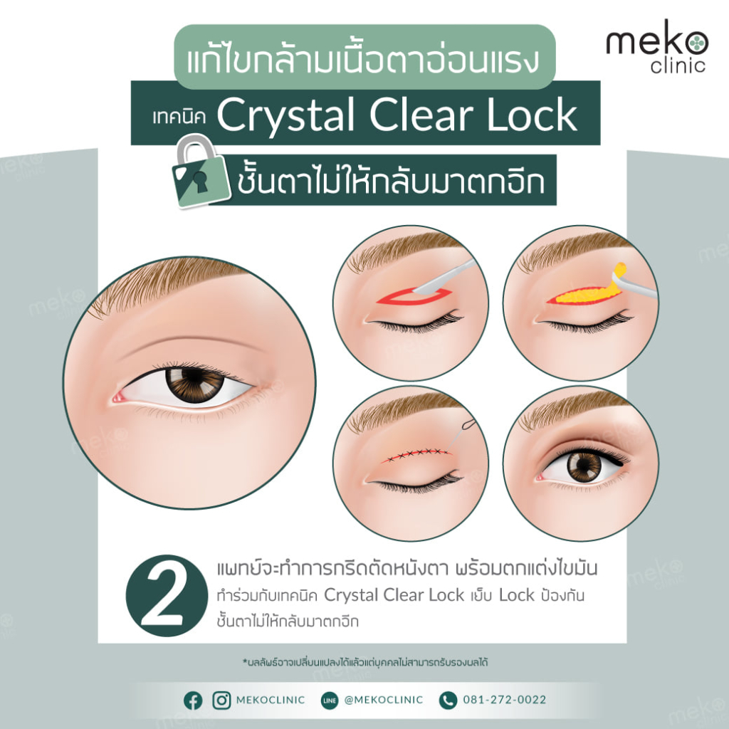 แก้ไขกล้ามเนื้อตาอ่อนแรงเทคนิค crystal clear lock-2