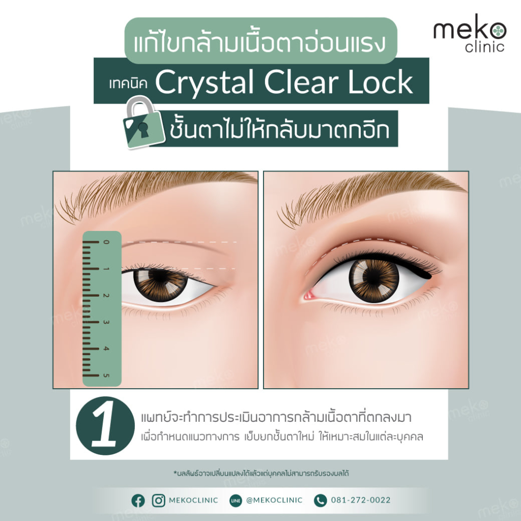 แก้ไขกล้ามเนื้อตาอ่อนแรงเทคนิค crystal clear lock