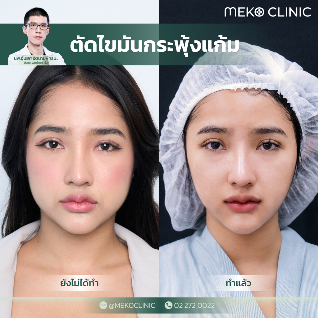 ตัดไขมันกระพุ้งแก้ม (Buccal Fat Pad Removal) - Meko Clinic ตัดไขมันกระพุ้งแก้ม (Buccal Fat Pad Removal) - Meko Clinic