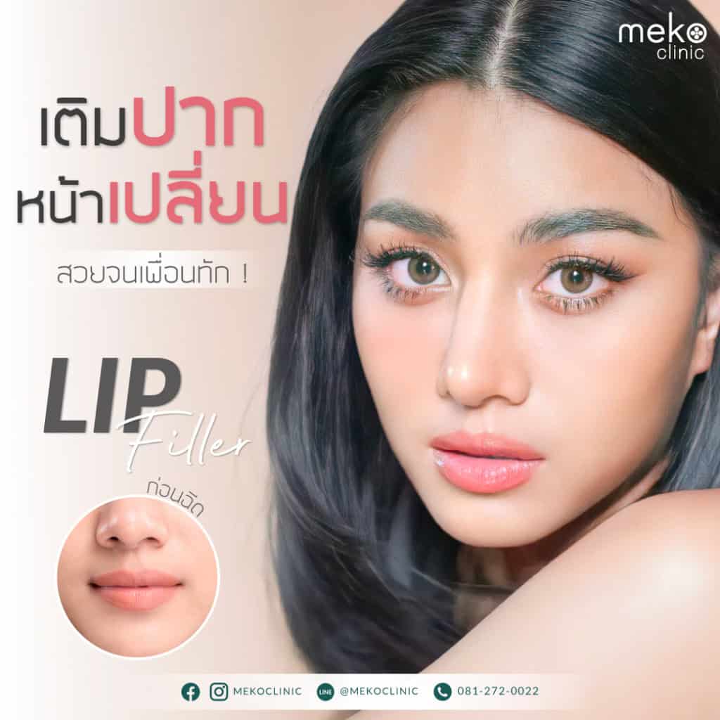 Filler lips, by Dr. Mew (Khun Bia)