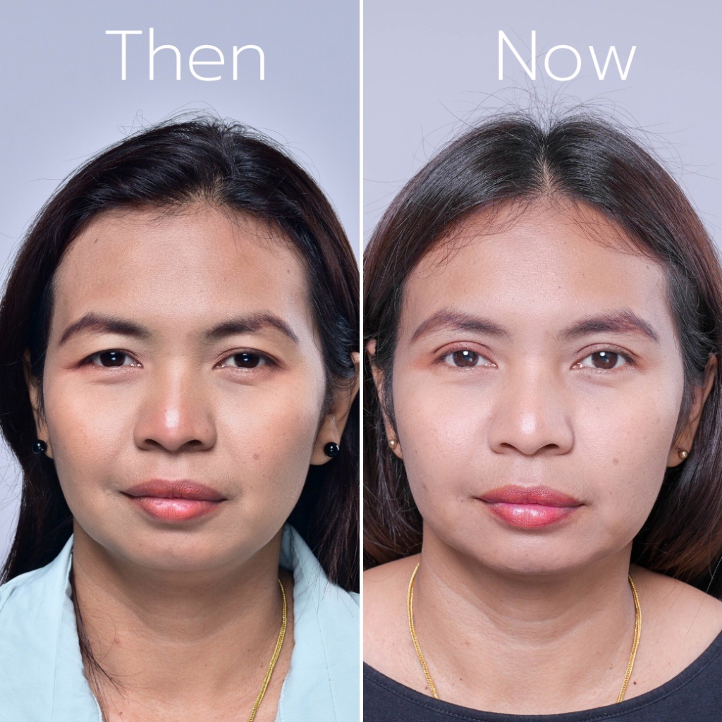 รีวิวตาสองชั้น หนังตาตก อายุ 40 ปี CSR – SHINY EYES BY MEKO-10