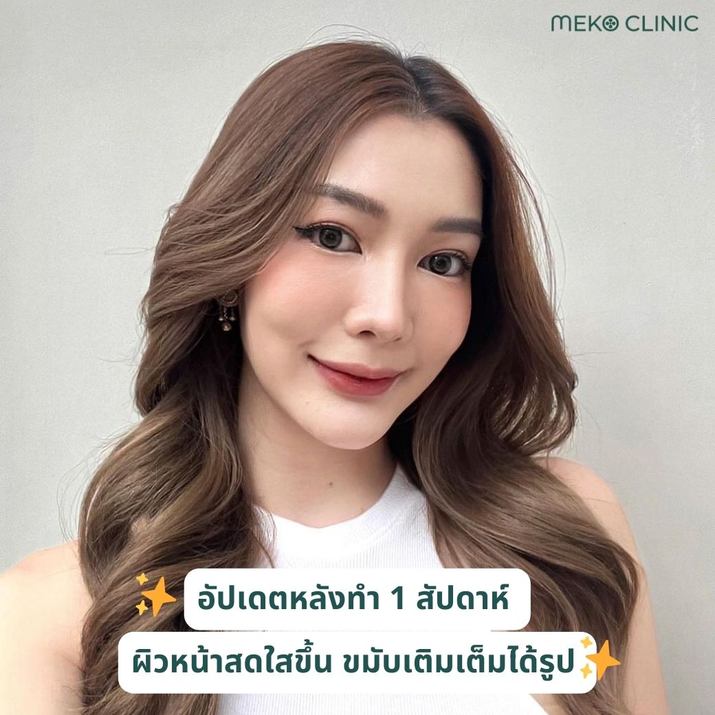 หลังฉีดฟิลเลอร์ขมับ / Filler skin booster