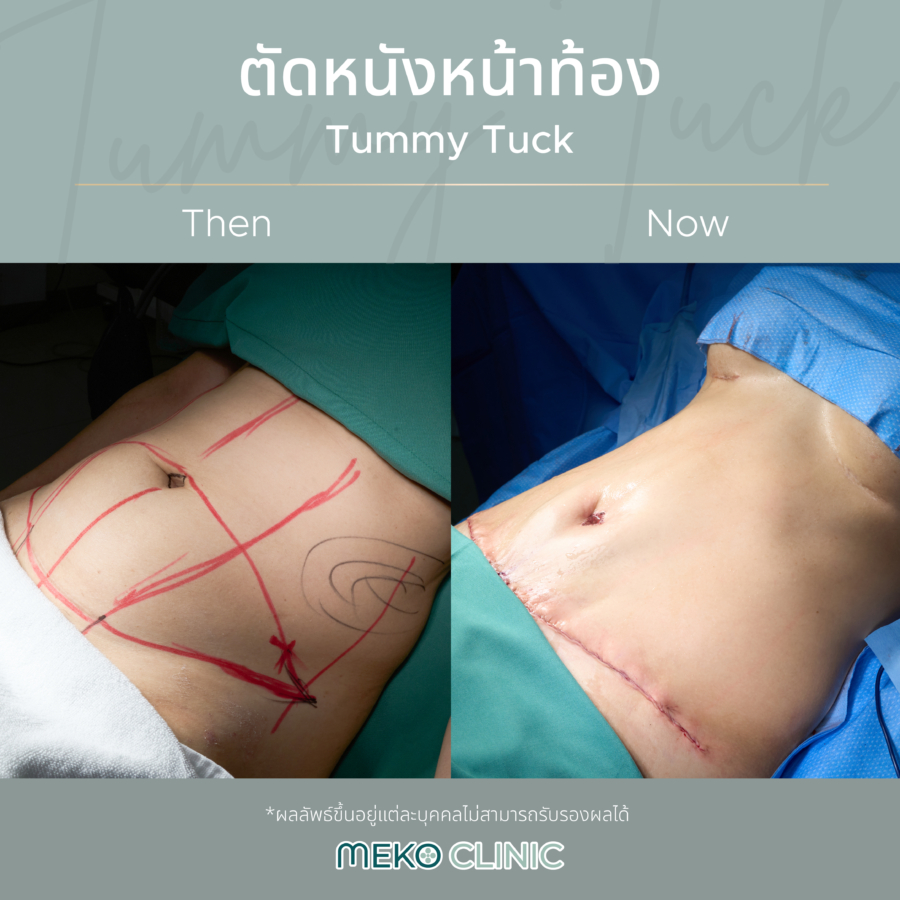 ตัดหนังหน้าท้อง Tummy Tuck เมโกะ-3