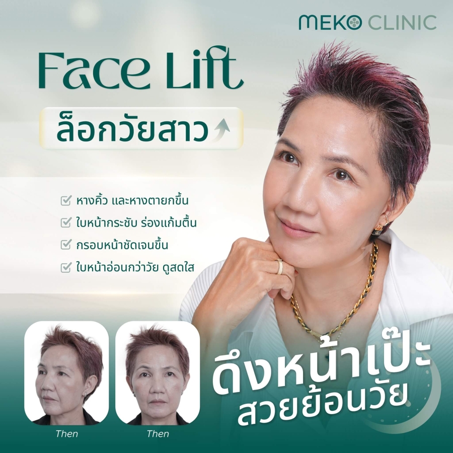 ประโยชน์ของการ ผ่าตัดดึงหน้า (Facelift)