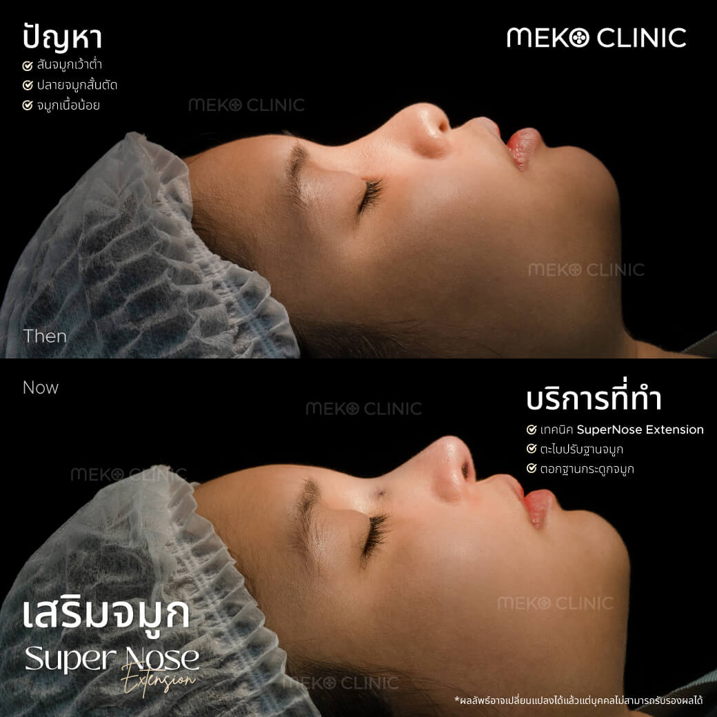 รีวิว-เสริมจมูก-ภัทรสุดา-หมอปรัช-01