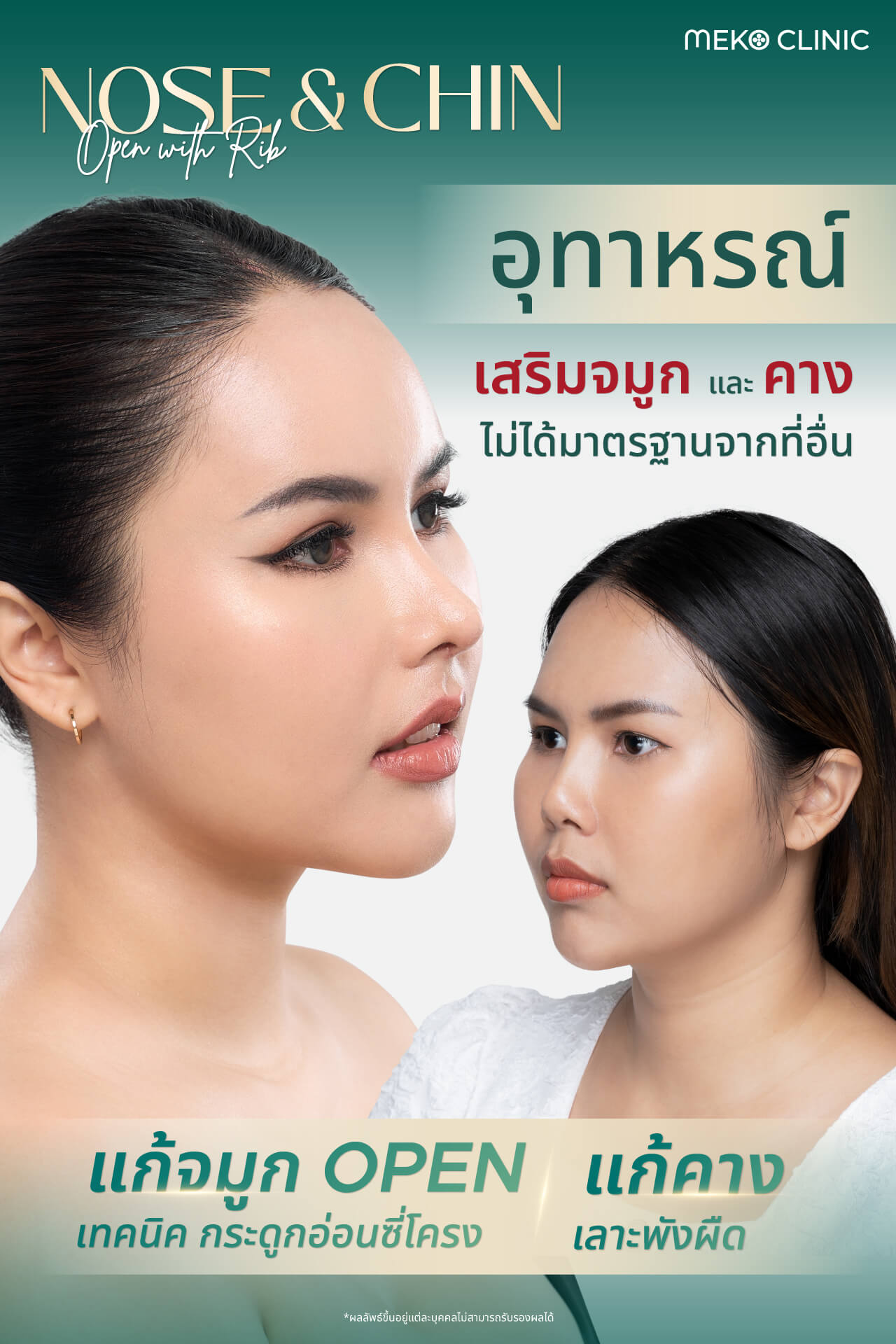 รีวิวศัลยกรรมแก้จมูกเทคนิค Open ด้วยซี่โครง คุณจ๋า-1