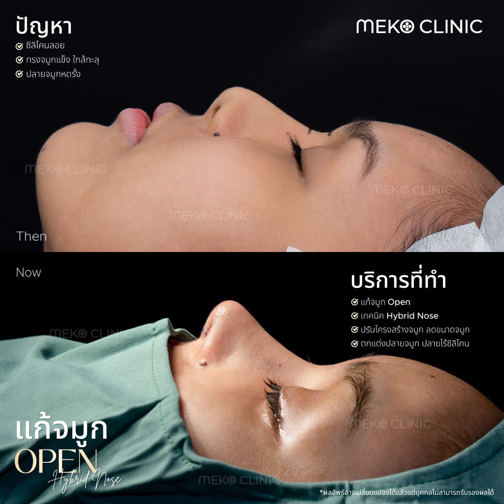 รีวิวศัลยกรรมแก้จมูกเทคนิค Open ส่วนหลังหู พร้อมยืดผนังกั้นจมูกกับตะไบและตอกฐาน คุณบูม-1