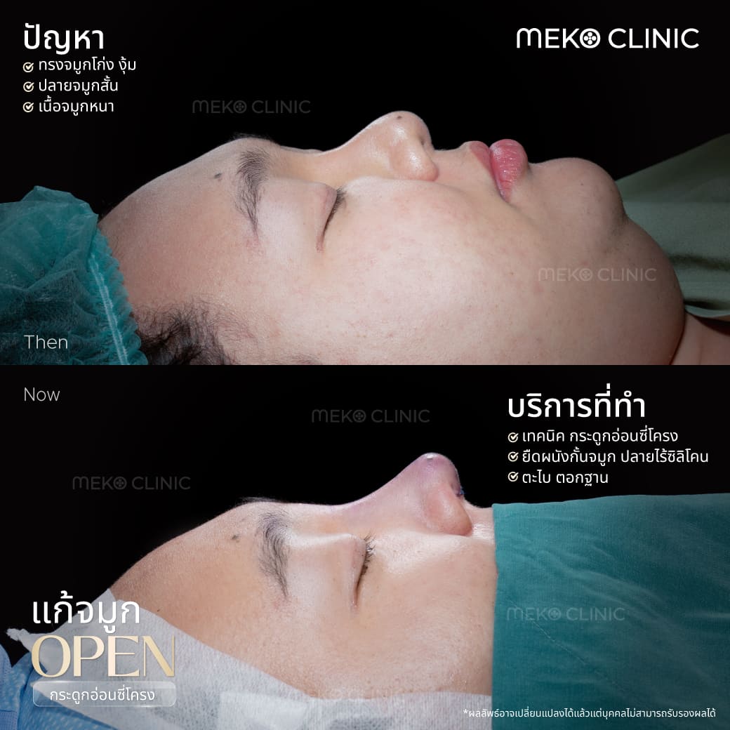 รีวิวแก้จมูก-เทคนิคopen-ตกแต่งปลายจมูก-ตะไบจมูก-เอแคลร์-จือปาก