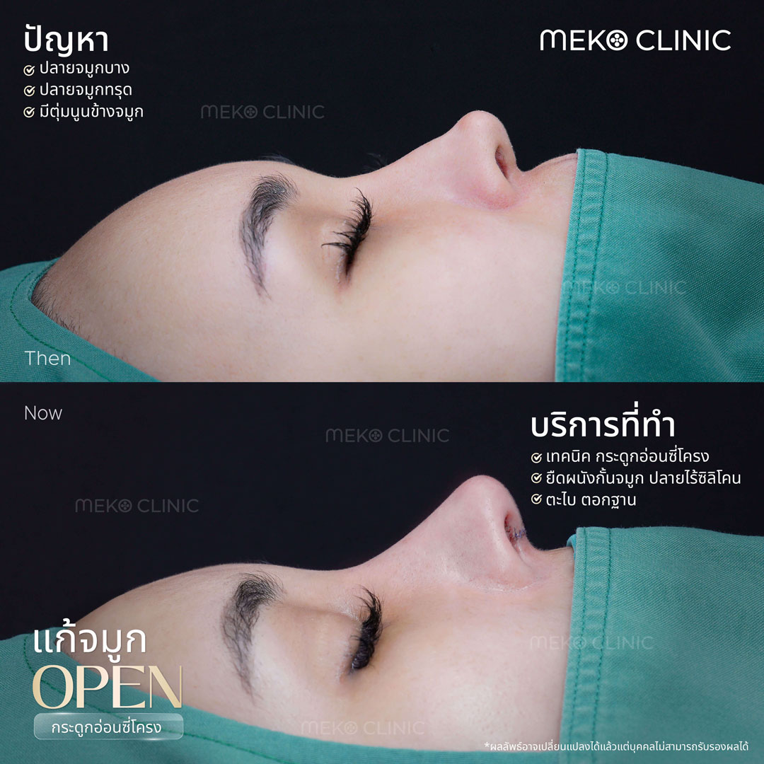 รีวิวแก้จมูกเทคนิค Open ด้วยซี่โครง คุณแมลงเมี่ยง-1