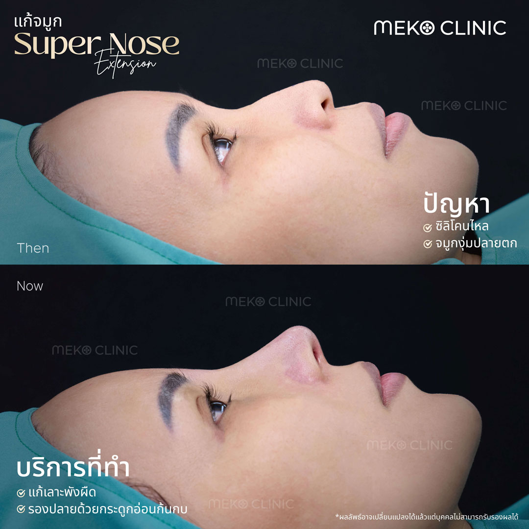 รีวิวแก้จมูกแบบปิด ด้วยเทคนิค SuperNose Extension-1