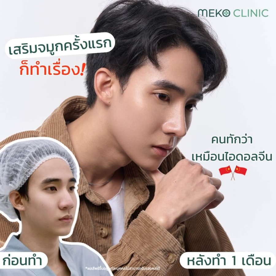 หลังเสริมจมูก 1 เดือน